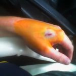 Innesto Microchip per i dipendenti USA. Sarà sottopelle tra pollice ed indice 1