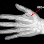 Innesto Microchip per i dipendenti USA. Sarà sottopelle tra pollice ed indice 1 Innesto Microchip per i dipendenti USA. Sarà sottopelle tra pollice ed indice 2